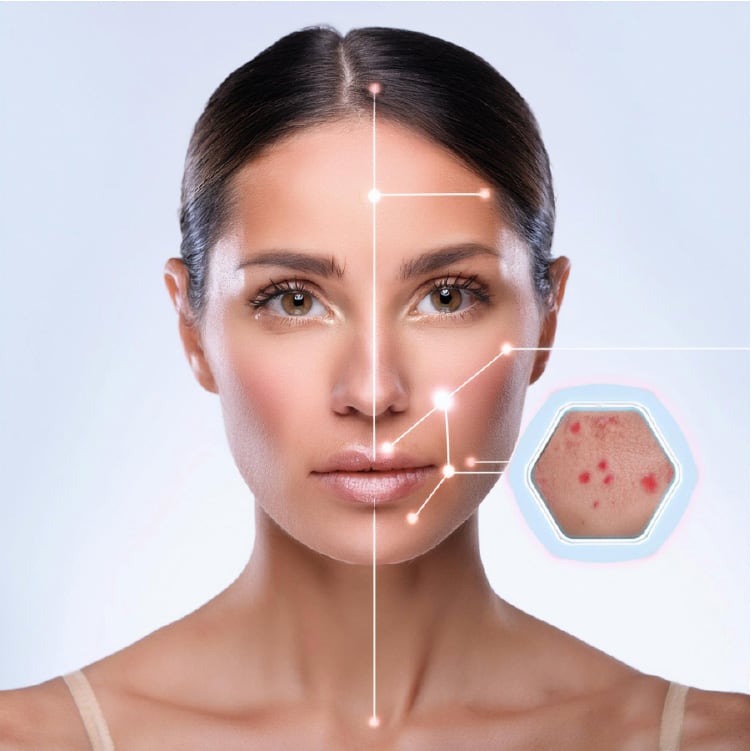 Modelo en la que se le hace zoom en los labios y se le ve acne